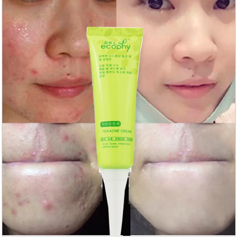 30g Soothing Acne Repair Tea Tree Cleansing Acne Cream Moisturize Face Anti acne Treatment Cream Control Oil Skin Care Face
30g Soothing Acne Repair Tea Tree Cleansing Acne Cream Moisturize Face Anti acne Treatment Cream Control Oil Skin Care Face