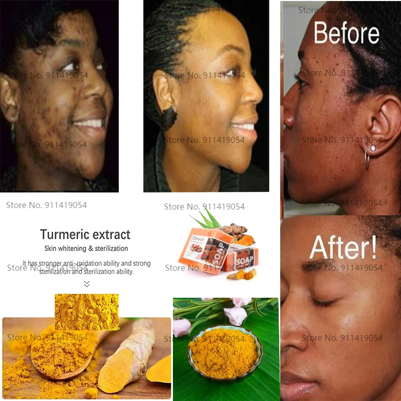 Tumeric Anti Acne Soap Natural To Lightening Acne Treatment Dark Spots Skin Glow Brighter Scars Removal Acne Scars Bars
Tumeric Anti Acne Soap Natural To Lightening Acne Treatment Dark Spots Skin Glow Brighter Scars Removal Acne Scars Bars