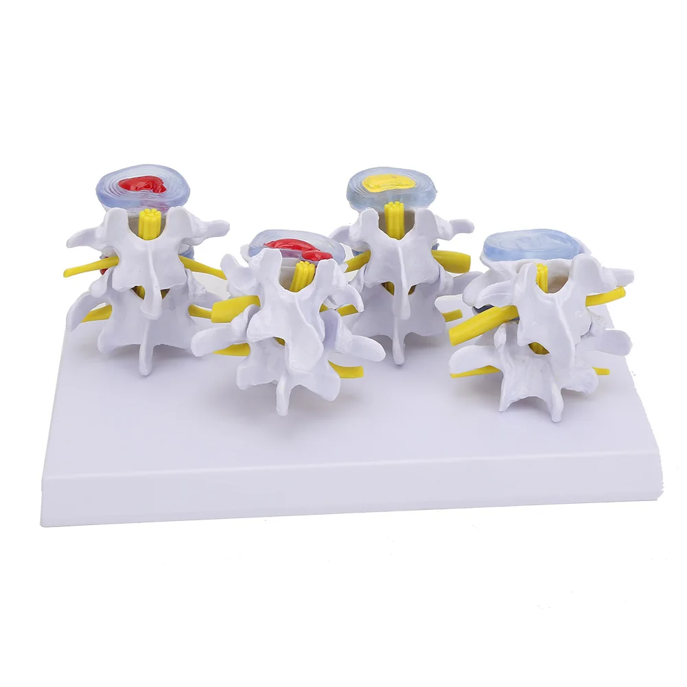 4-stage Medicals Human Lumbar Vertebrae Combination of Normal and Pathological Models
4-stage Medicals Human Lumbar Vertebrae Combination of Normal and Pathological Models