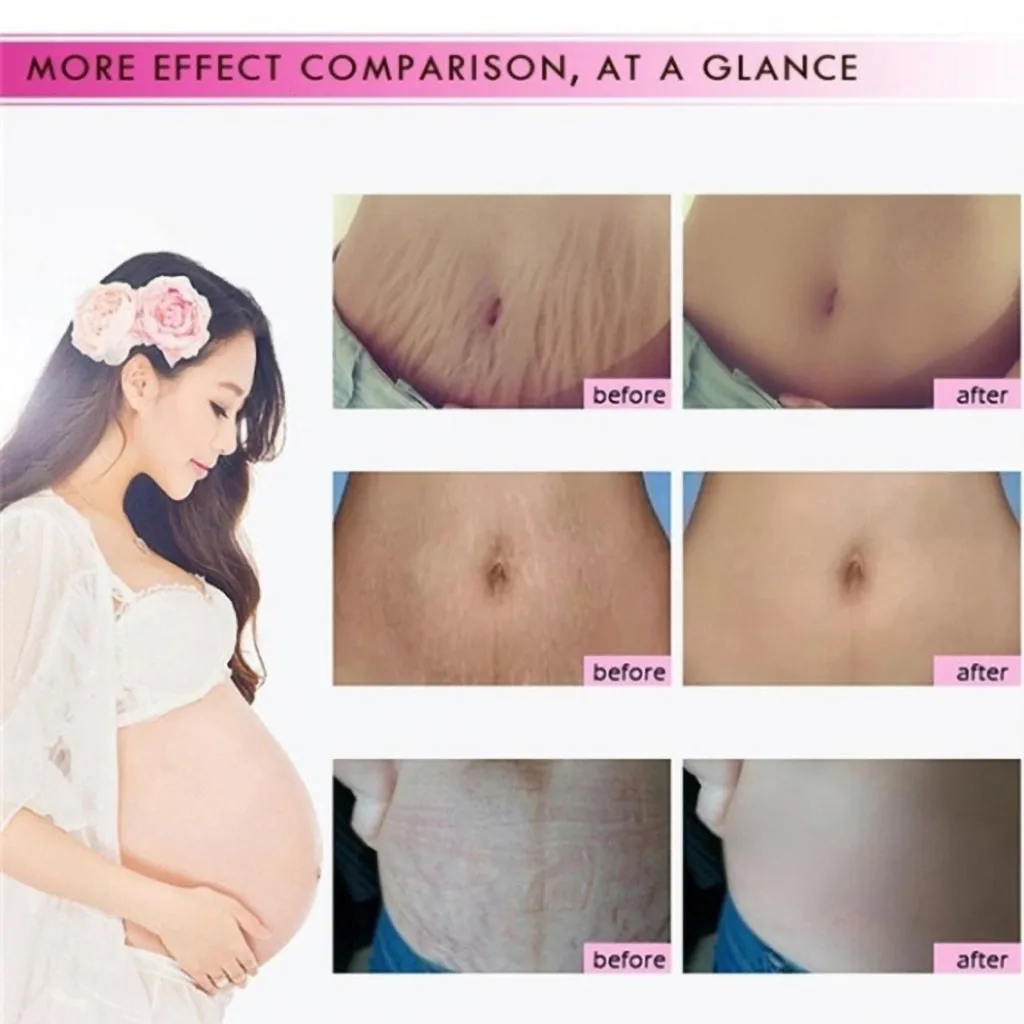 Natural Removal Acne Scar Stretch Marks Cream Fat Scar Striae Gravidarum Treatment Anti-Aging Anti-Winkles Firming Body Creams
Natural Removal Acne Scar Stretch Marks Cream Fat Scar Striae Gravidarum Treatment Anti-Aging Anti-Winkles Firming Body Creams