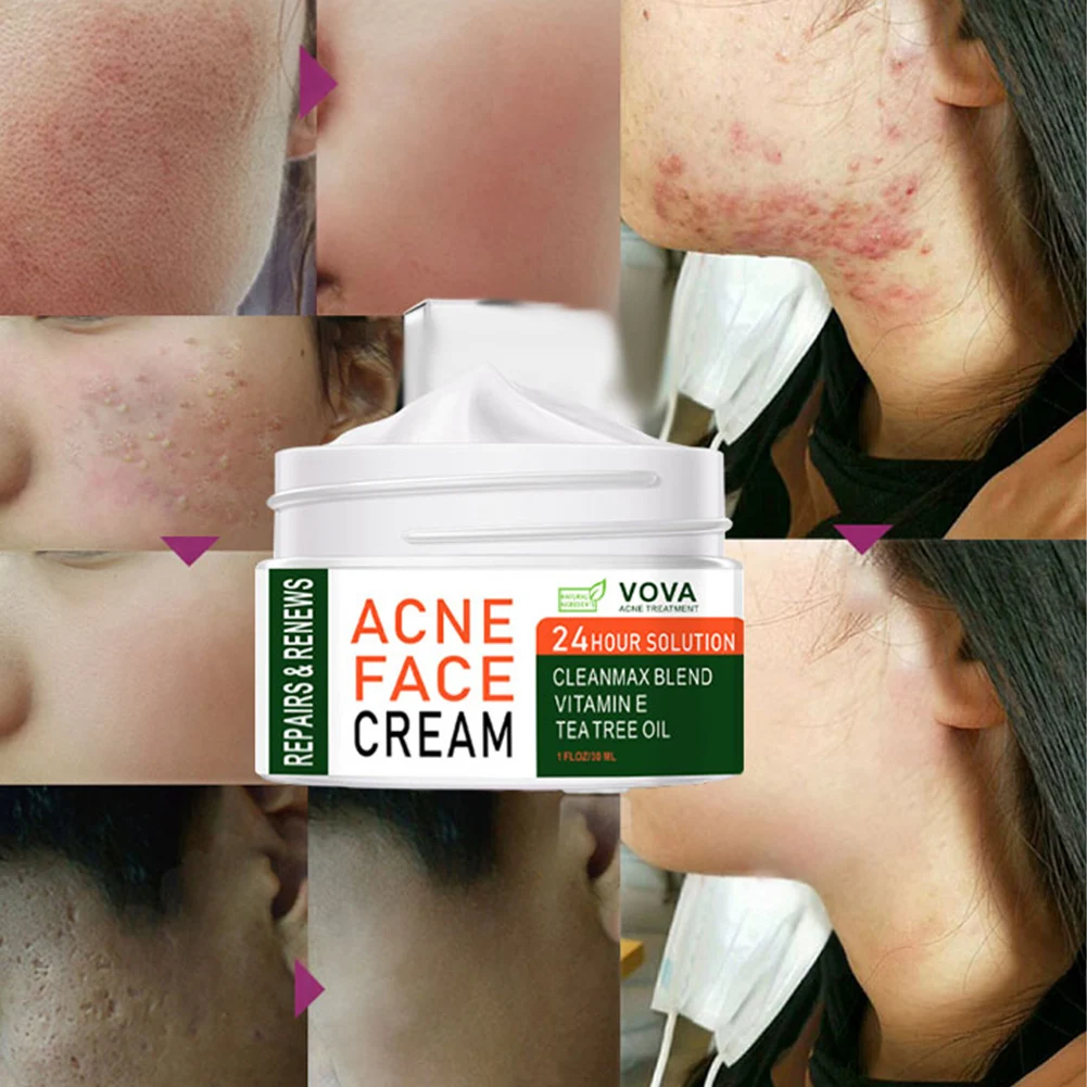 VOVA Effective Acne Removal Cream Acne Treatment Fade Acne Spots Oil Control Shrink Pores Whitening Moisturizing Acne Cream Skin
VOVA Effective Acne Removal Cream Acne Treatment Fade Acne Spots Oil Control Shrink Pores Whitening Moisturizing Acne Cream Skin