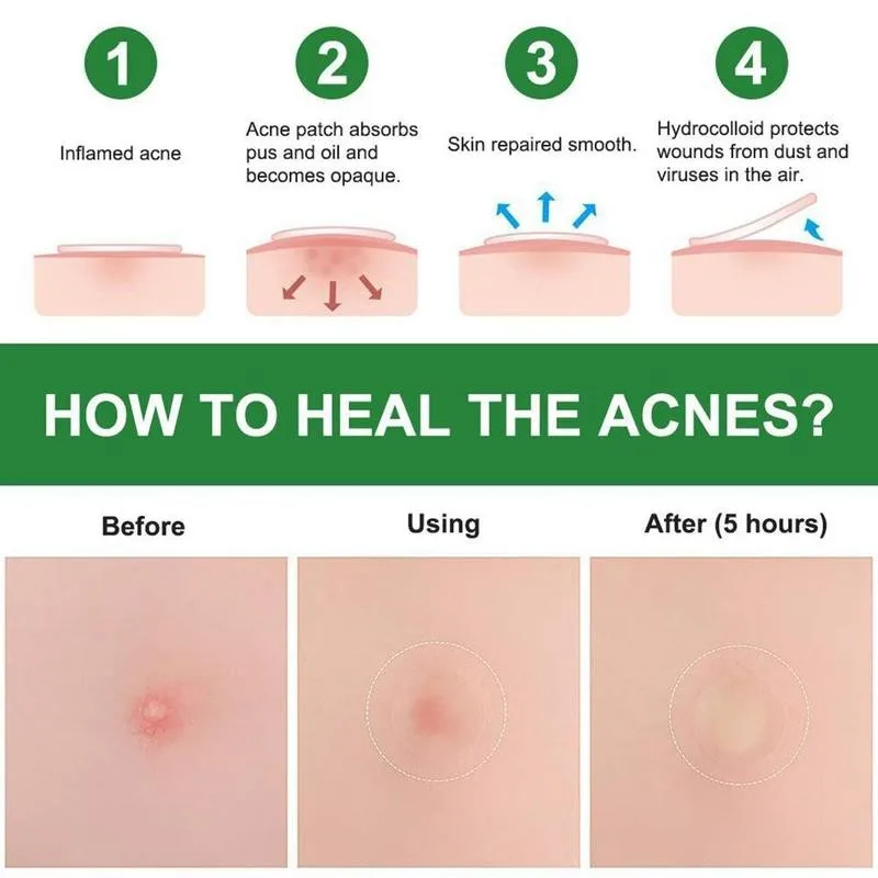 24pcs/set Acne Pimple Patch Invisible Beauty Acne Patch Stickers Blemish Treatment Scar Care Treatment Stickers Skin Care Makeup
24pcs/set Acne Pimple Patch Invisible Beauty Acne Patch Stickers Blemish Treatment Scar Care Treatment Stickers Skin Care Makeup