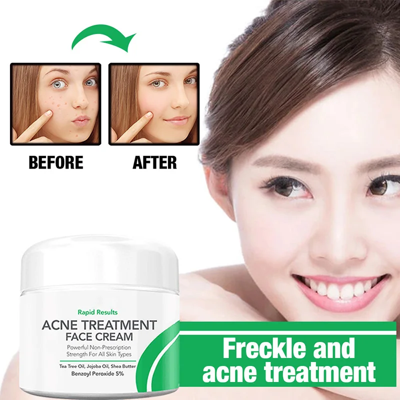 Anti-Acne Oil Control Cream Shrink Pores Nourishing Whitening Remove Acne Facial Skin Care EY669
Anti-Acne Oil Control Cream Shrink Pores Nourishing Whitening Remove Acne Facial Skin Care EY669