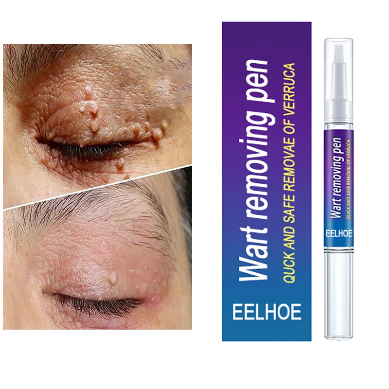 3ML Liquid Warts Tag Remover Pen Skin Tag Remover Wart Armpit Flat Acne Spot Treatment Anti Skin Feet Corn Ointment Skin Care
3ML Liquid Warts Tag Remover Pen Skin Tag Remover Wart Armpit Flat Acne Spot Treatment Anti Skin Feet Corn Ointment Skin Care