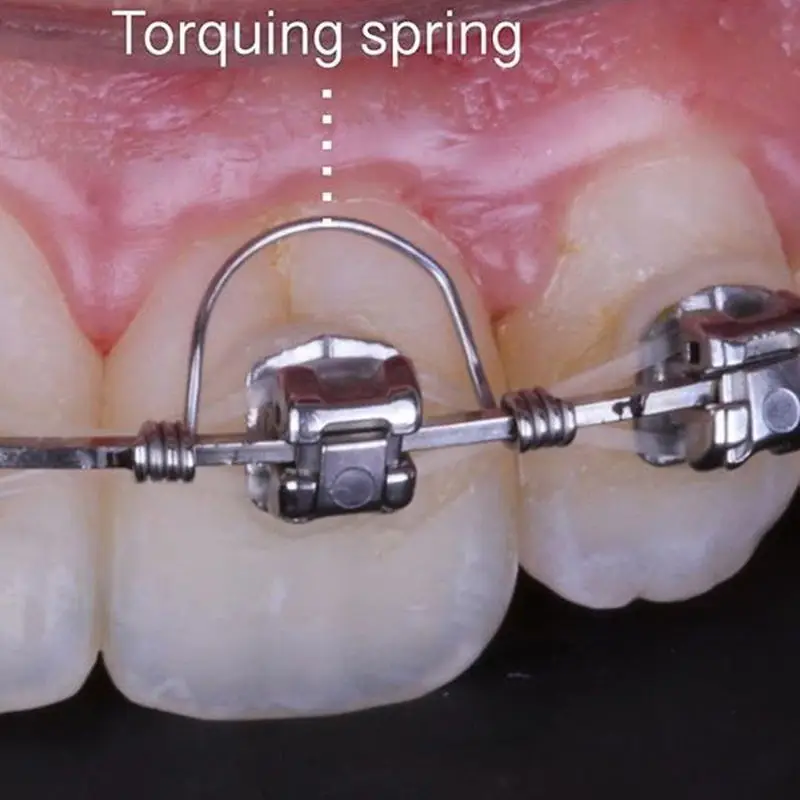 10Pcs/bag Orthodontic Torquing Spring Orthodontist Spring Stainless Steel Single Anterior Teeth Torque Springs Rectangular
10Pcs/bag Orthodontic Torquing Spring Orthodontist Spring Stainless Steel Single Anterior Teeth Torque Springs Rectangular