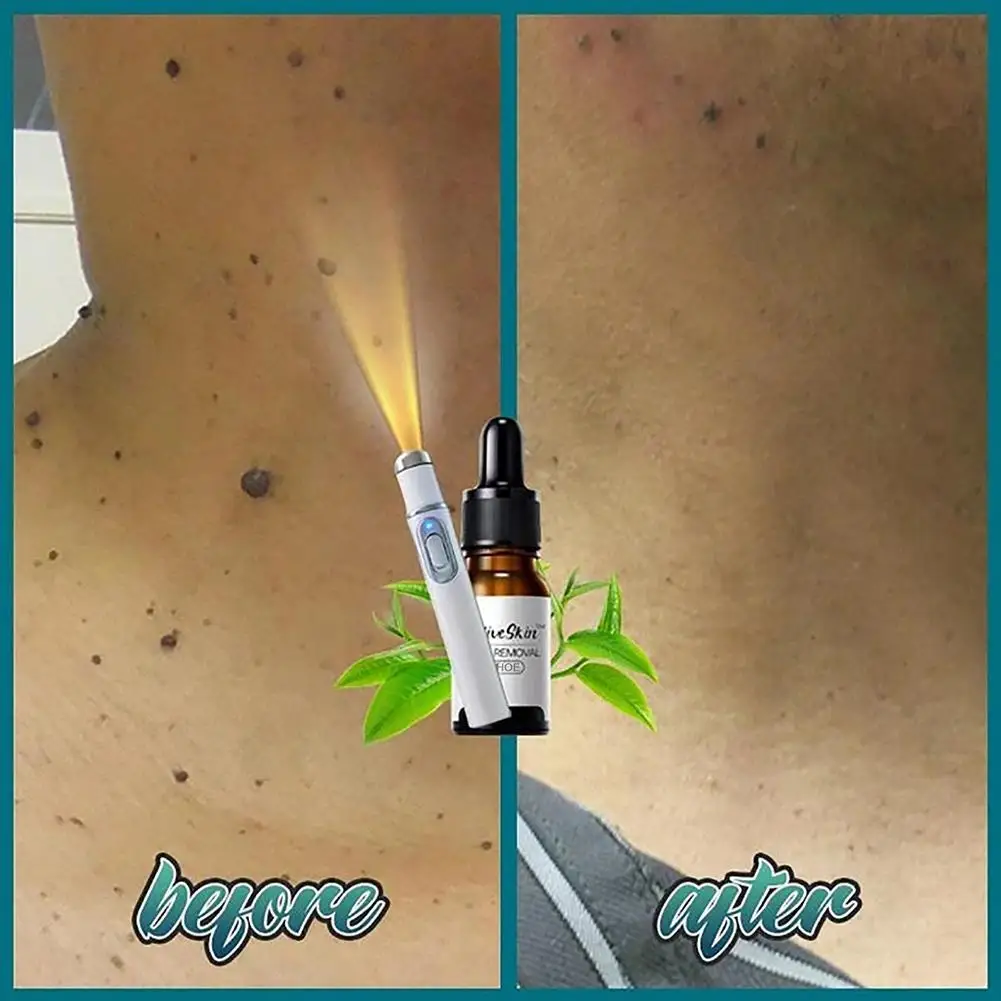 Painless Wart Removal Set Skin Tag Remover Treatment Remover Wart Face Care Mole Serum Unisex Remover Natural Z5Q0
Painless Wart Removal Set Skin Tag Remover Treatment Remover Wart Face Care Mole Serum Unisex Remover Natural Z5Q0