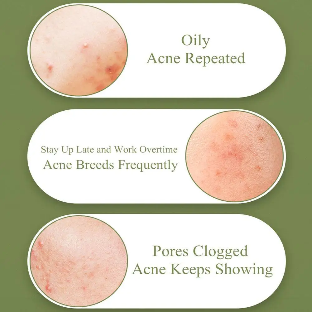 15g Acne Treatment Gel Cream Eliminate Acne Removal Oil Control Moisturizer Repair Spot Shrink Pores Anti Acne Serum Skin Care
15g Acne Treatment Gel Cream Eliminate Acne Removal Oil Control Moisturizer Repair Spot Shrink Pores Anti Acne Serum Skin Care
