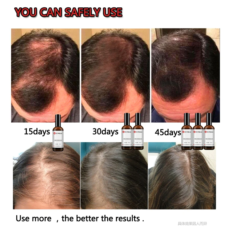 100ML Anti Hair Loss Products Hair Growth Spray Essential Oil Liquid for Men Women Growth Essence Serum Hair Care Repair Growing 
100ML Anti Hair Loss Products Hair Growth Spray Essential Oil Liquid for Men Women Growth Essence Serum Hair Care Repair Growing