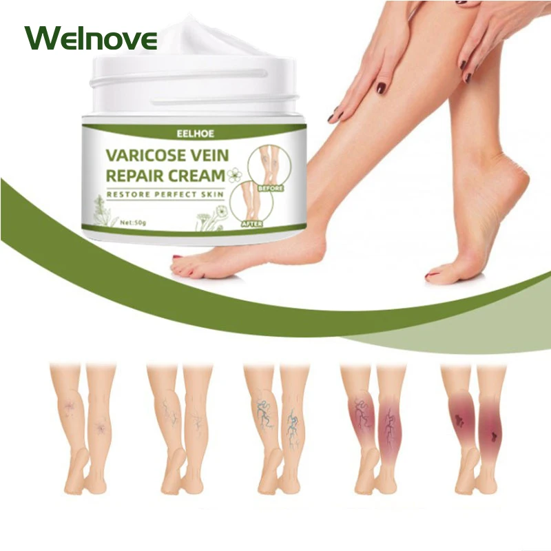 Varicose Vein Cream 50g Spider Leg Treatment Ointment Repair Vasculitis Phlebitis Massage Plaster Relieve Swelling Skin Care
Varicose Vein Cream 50g Spider Leg Treatment Ointment Repair Vasculitis Phlebitis Massage Plaster Relieve Swelling Skin Care