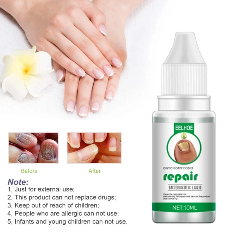 Eelhoe Nail Fungus Treat Onychomycosis Toe Treat Feet Care Nail Repair Anti Infections Paronychia Onychomycosis Nails Care
Eelhoe Nail Fungus Treat Onychomycosis Toe Treat Feet Care Nail Repair Anti Infections Paronychia Onychomycosis Nails Care
