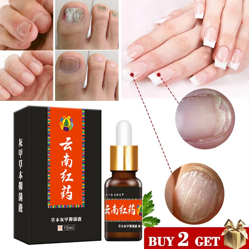 Nail Fungal Treatment Essence Serum Nail Foot Whitening Toe Nail Fungus Removal Gel Paronychia Nail Anti Infection Repair 15ml
Nail Fungal Treatment Essence Serum Nail Foot Whitening Toe Nail Fungus Removal Gel Paronychia Nail Anti Infection Repair 15ml