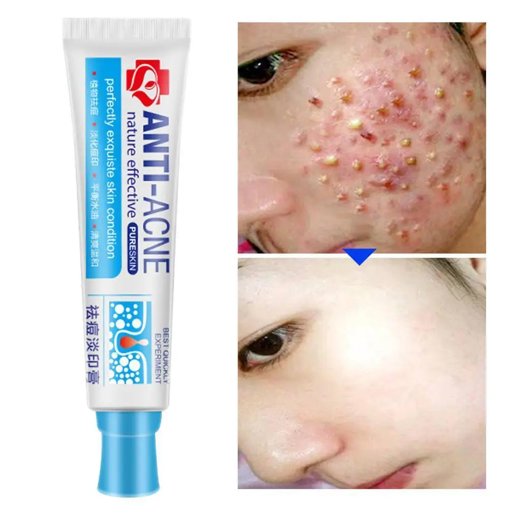 Traditional Chinese Medicine Acne Treatment Face Cream Creams Whitening Shrink Gel 30ml Spots Moisturizing Bleaching Pores O8I3
Traditional Chinese Medicine Acne Treatment Face Cream Creams Whitening Shrink Gel 30ml Spots Moisturizing Bleaching Pores O8I3