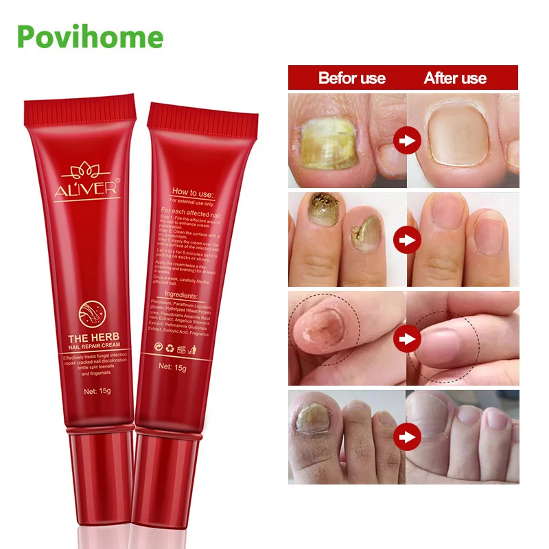 1Pcs 15g Nail Repair Treatment Ointment Whitening Toe Nail Fungus Dead Skin Removal Gel Anti Infection Onychomycosis Cream P1127
1Pcs 15g Nail Repair Treatment Ointment Whitening Toe Nail Fungus Dead Skin Removal Gel Anti Infection Onychomycosis Cream P1127