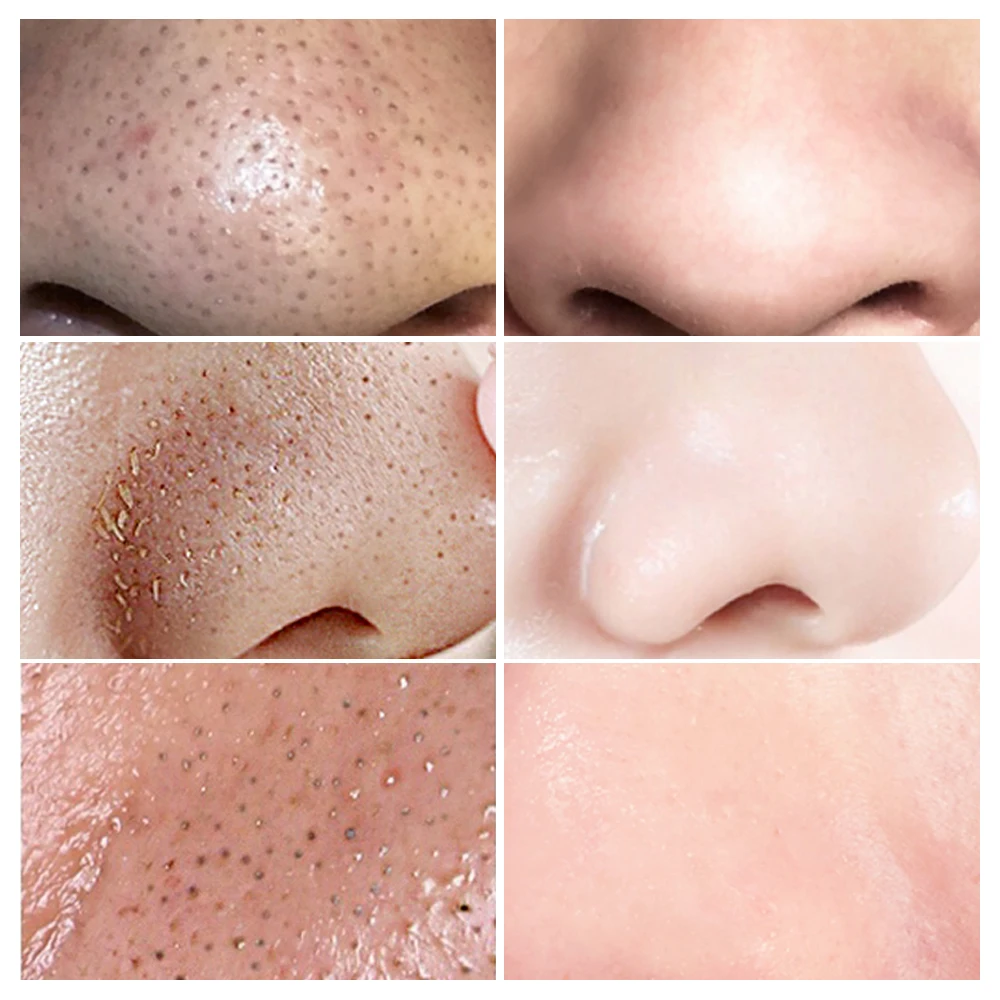 LANBENA Shrink Pores Blackhead Remover Mask Serum Deep Cleaning Shrink Pores Purifying Acne Treatment Essence Beauty Skin Care 
LANBENA Shrink Pores Blackhead Remover Mask Serum Deep Cleaning Shrink Pores Purifying Acne Treatment Essence Beauty Skin Care