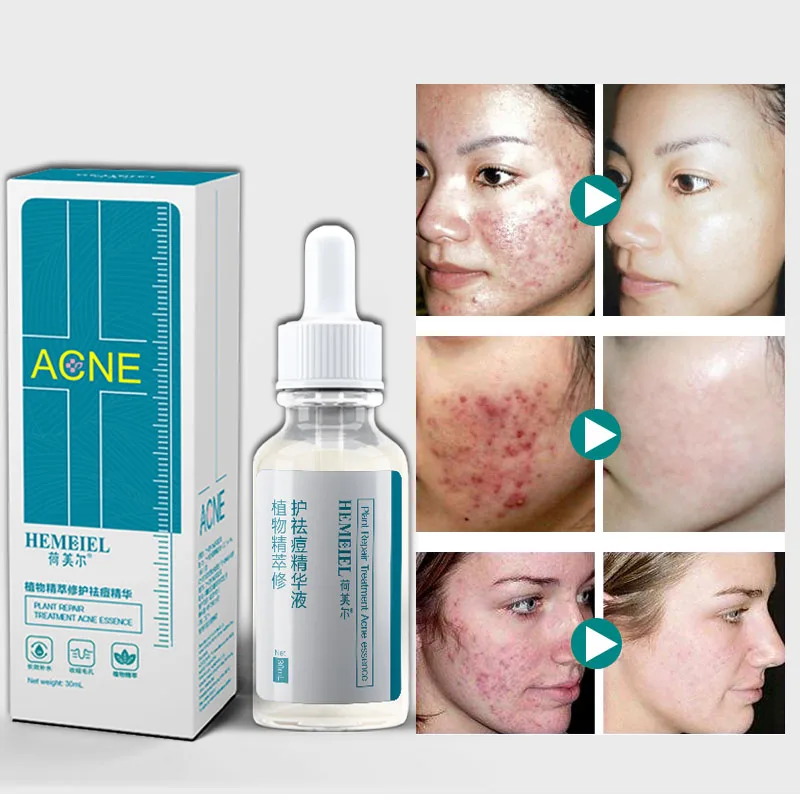 Hemeiel 30ml Acne Treatment Repair Nature Herbal Essence Serum Cream Pimple Face Skin Care Anti Wrinkle Pore Shrink Oil Control
Hemeiel 30ml Acne Treatment Repair Nature Herbal Essence Serum Cream Pimple Face Skin Care Anti Wrinkle Pore Shrink Oil Control