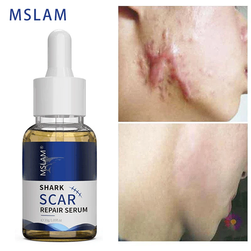 Сыворотка для восстановления шрамов акулы, лечение акне, удаление растяжек, хирургическое удаление шрамов, корректор пигментации тела, отб...
Сыворотка для восстановления шрамов акулы, лечение акне, удаление растяжек, хирургическое удаление шрамов, корректор пигментации тела, отб...