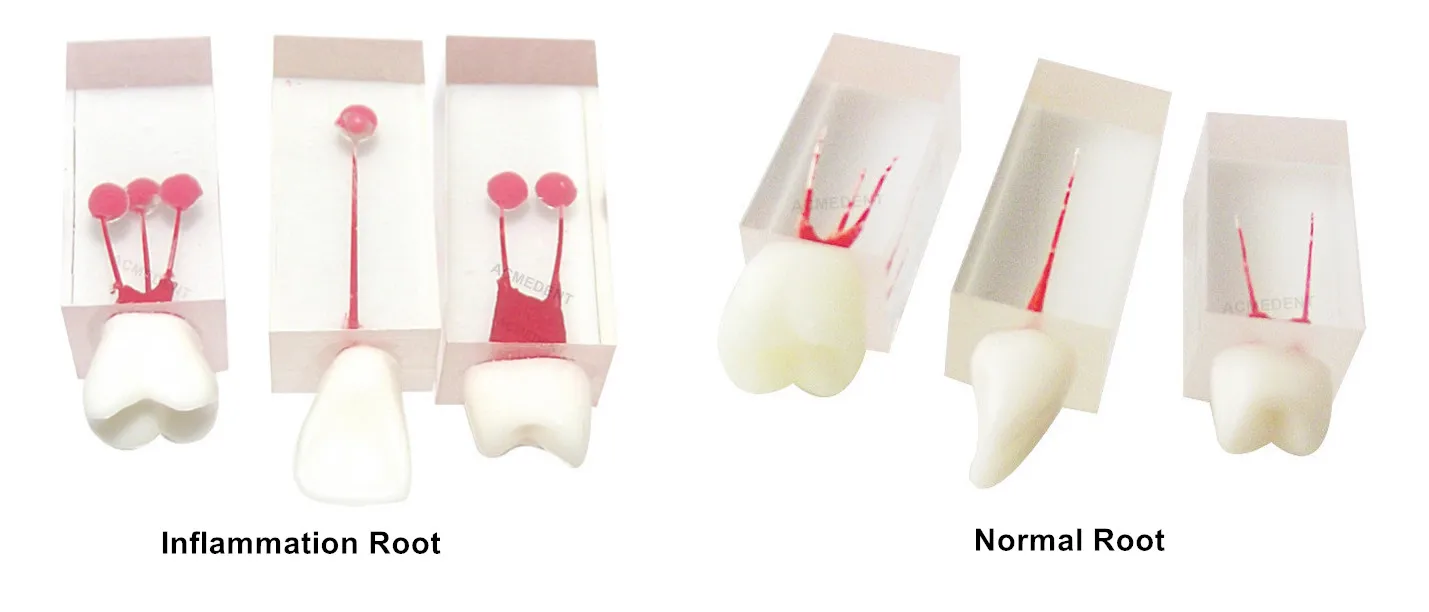 

Стоматологический обучающий блок для корневого канала RCT, 6 шт., обучающая модель для обучения эндодонтической целлюлозы, нормальное надувание, аппическая зубная Корона