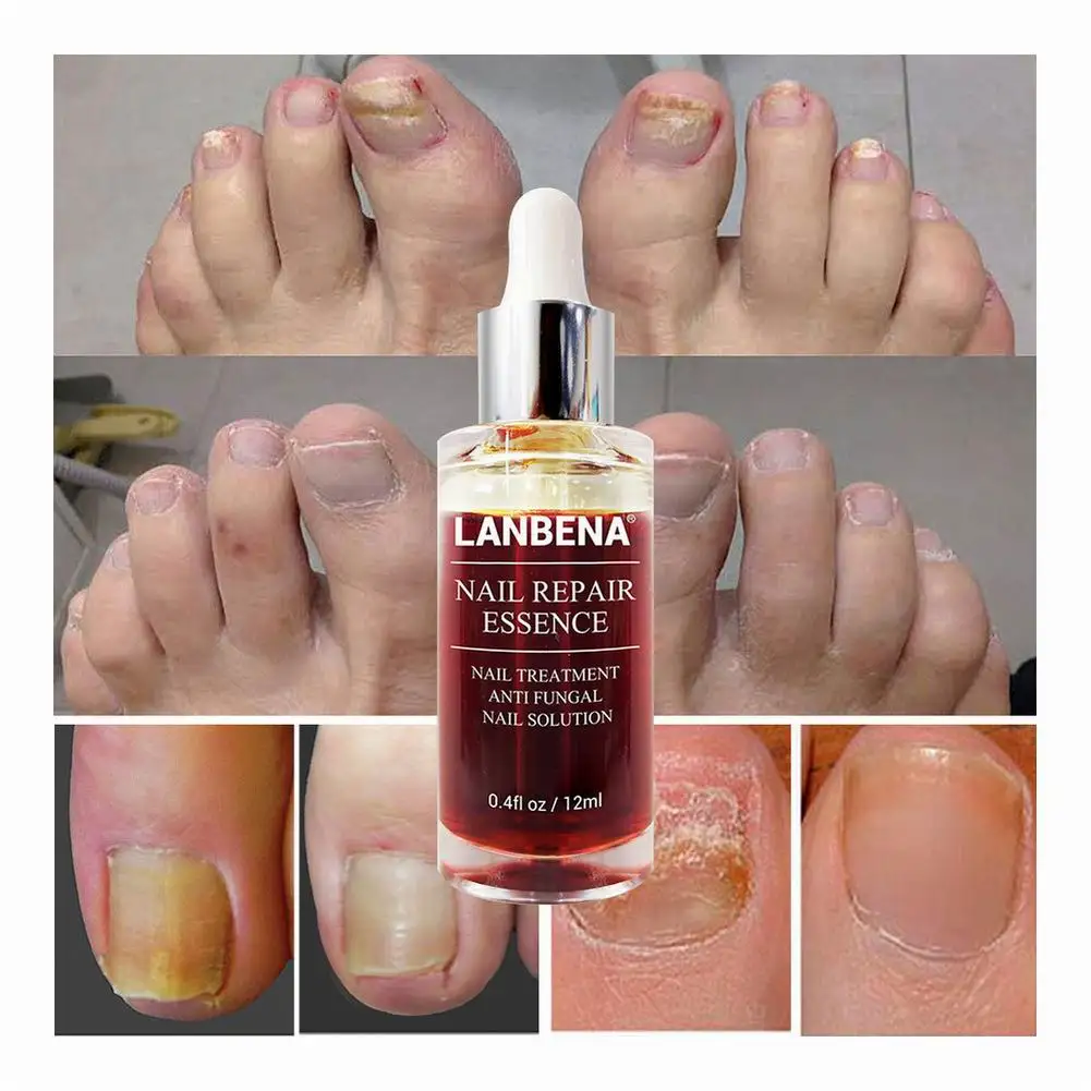 Nail Repair Nail Solution Natural Nail Treatment Effective Against Nail Infection Restores Discolored and Damaged Nails 12ml
Nail Repair Nail Solution Natural Nail Treatment Effective Against Nail Infection Restores Discolored and Damaged Nails 12ml
