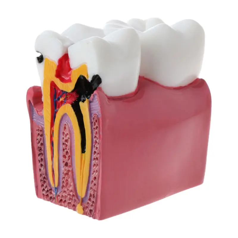 6 Times Dental Caries Comparation Anatomy Teeth Model for Dental Anatomy Lab Teaching Studying Researching Tool
6 Times Dental Caries Comparation Anatomy Teeth Model for Dental Anatomy Lab Teaching Studying Researching Tool