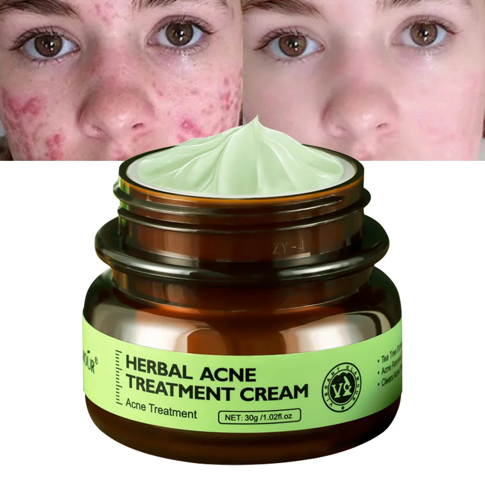 Herbal Acne Treatment Cream Oil Control Brighten Nourish Whitening Shrink Pores Remove Scars Marks Skin Care 30g
Herbal Acne Treatment Cream Oil Control Brighten Nourish Whitening Shrink Pores Remove Scars Marks Skin Care 30g