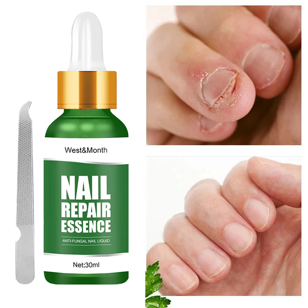 Fungal Nail Repair Essence Anti Infection Nail Fungus Removal Serum For Cracked Discolored Brittle Foot Nail Care
Fungal Nail Repair Essence Anti Infection Nail Fungus Removal Serum For Cracked Discolored Brittle Foot Nail Care