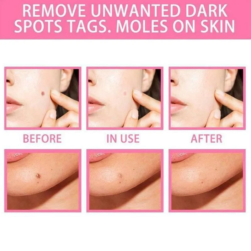 Mole Water Moisturizing Tag Remover Serum Mole Removal Repair Face Care Removal Solution Care Skin Solution Cream Tool L E4G2
Mole Water Moisturizing Tag Remover Serum Mole Removal Repair Face Care Removal Solution Care Skin Solution Cream Tool L E4G2