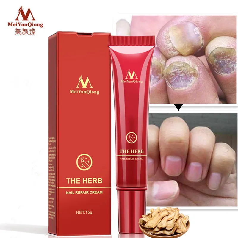 2021hot MeiyanQiong Nail Care Herbal Nail Repair Cream Anti Fungal Nail Chinese Herbal Toe Nail Fungus Treatment
2021hot MeiyanQiong Nail Care Herbal Nail Repair Cream Anti Fungal Nail Chinese Herbal Toe Nail Fungus Treatment