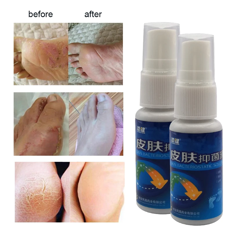 1Pcs Beriberi Removal Cream Anti Bacterial Foot Spray for Feet Rotten Peeling Itching Blisters Remove Sweat Odor Feet Ointment
1Pcs Beriberi Removal Cream Anti Bacterial Foot Spray for Feet Rotten Peeling Itching Blisters Remove Sweat Odor Feet Ointment