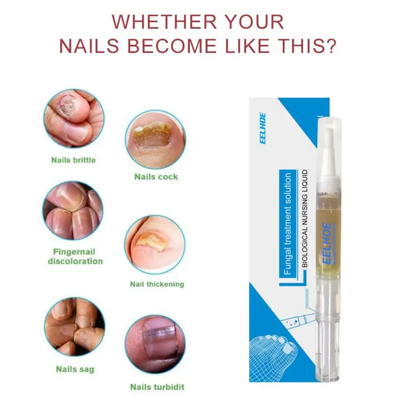 Fungal Nail Nail Fungus Removal Gel Anti Paronychia Onychomycosis Pen Onychomycosis Paronychia Anti Fungal Nail Chinese TSLM1
Fungal Nail Nail Fungus Removal Gel Anti Paronychia Onychomycosis Pen Onychomycosis Paronychia Anti Fungal Nail Chinese TSLM1