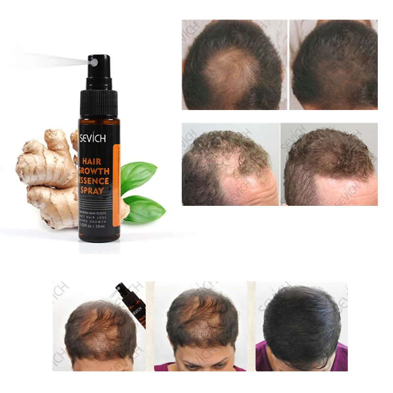 

Hair Regeneration Essence Spray Effectively Prevent Baldness Spray Repair Scalp And Hair Follicles Hair Nutrition Liquid TSLM1