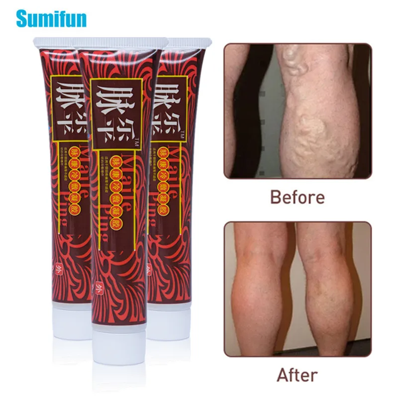 3pcs Varicose Veins Treatment Cream Vasculitis Phlebitis Spider Leg Pain Relief Ointment Medical Plaster Angiitis Removal Patch
3pcs Varicose Veins Treatment Cream Vasculitis Phlebitis Spider Leg Pain Relief Ointment Medical Plaster Angiitis Removal Patch