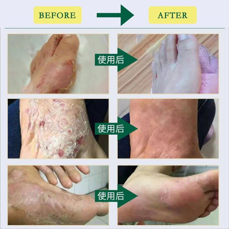 1Set Health Care Foot Soaking Powder Athlete's Feet Spray For Beriberi Sweaty Foot Odor Gel Suit Relieve Itching Peeling Blister 
1Set Health Care Foot Soaking Powder Athlete's Feet Spray For Beriberi Sweaty Foot Odor Gel Suit Relieve Itching Peeling Blister