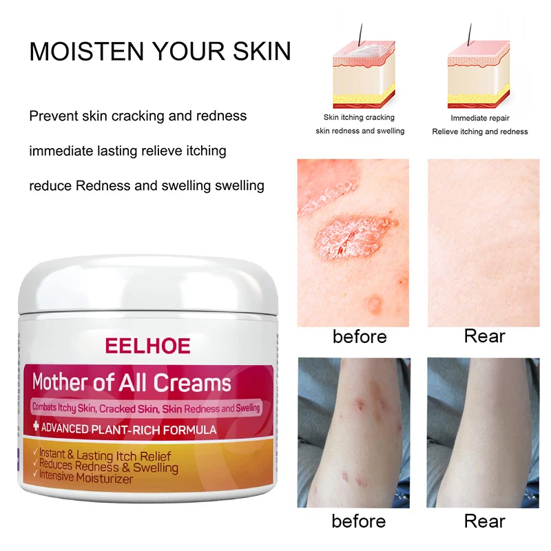 EELHOE Eczema Cream Skin Psoriasis Cream Dermatitis Eczematoid Eczema Ointment Treatment Psoriasis Relieve Various Skin Problem
EELHOE Eczema Cream Skin Psoriasis Cream Dermatitis Eczematoid Eczema Ointment Treatment Psoriasis Relieve Various Skin Problem
