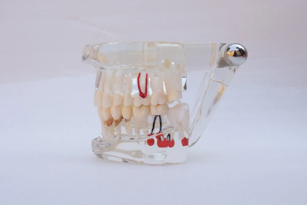 1pc dental teaching study model standard restoration with Implant dental model oral model
1pc dental teaching study model standard restoration with Implant dental model oral model