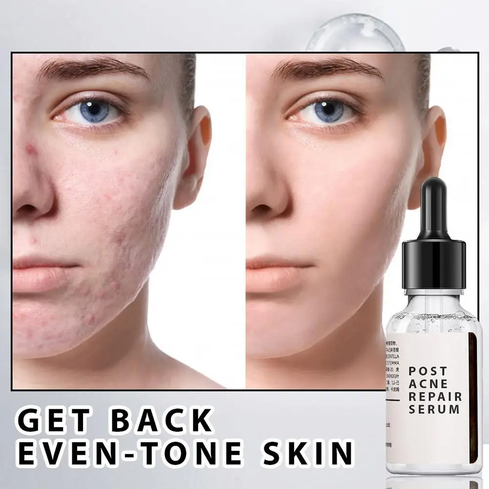 Acne Treatment Face Serum Anti Acne Essence Hydrating Essence Spot Whitening G3I4
Acne Treatment Face Serum Anti Acne Essence Hydrating Essence Spot Whitening G3I4