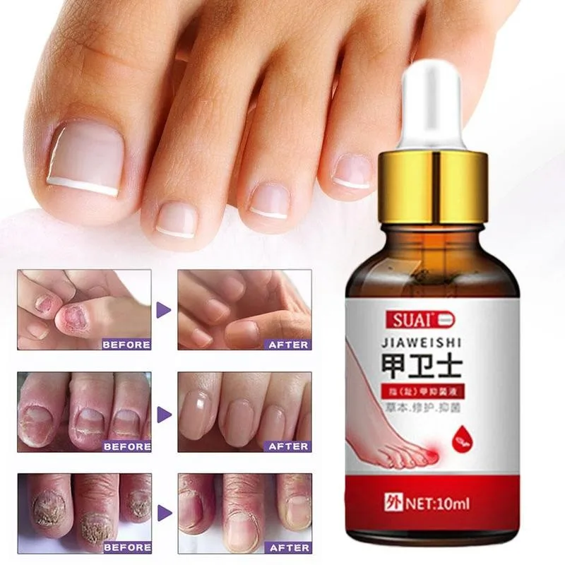Nail Fungal Treatment Feet Care Essence Nail Foot Whitening Infection Removal Onychomycosis Toe Paronychia Fungus Anti Nail W7P7
Nail Fungal Treatment Feet Care Essence Nail Foot Whitening Infection Removal Onychomycosis Toe Paronychia Fungus Anti Nail W7P7