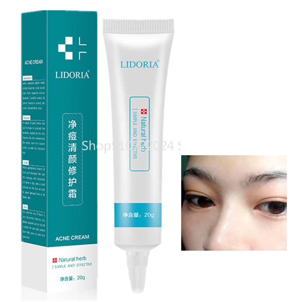 Efficient Repair Acne Cream Anti Spots Acne Treatment Scar Blackhead Cream Shrink Pores Whitening Moisturizing Face Skin Care
Efficient Repair Acne Cream Anti Spots Acne Treatment Scar Blackhead Cream Shrink Pores Whitening Moisturizing Face Skin Care