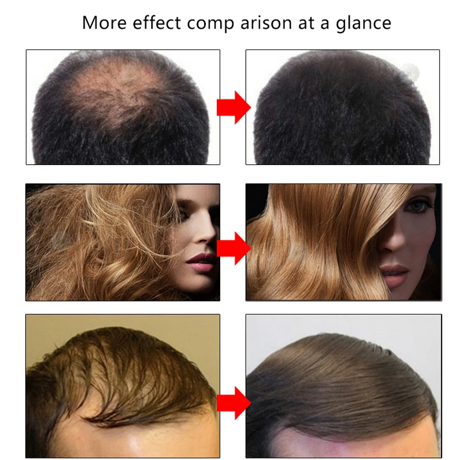 2pcs Fast Hair Growth Essence Oils Anti Hair Loss Treatment Dense Extract Hair Growth Serum Growing Hair Care Serum Restoration 
2pcs Fast Hair Growth Essence Oils Anti Hair Loss Treatment Dense Extract Hair Growth Serum Growing Hair Care Serum Restoration