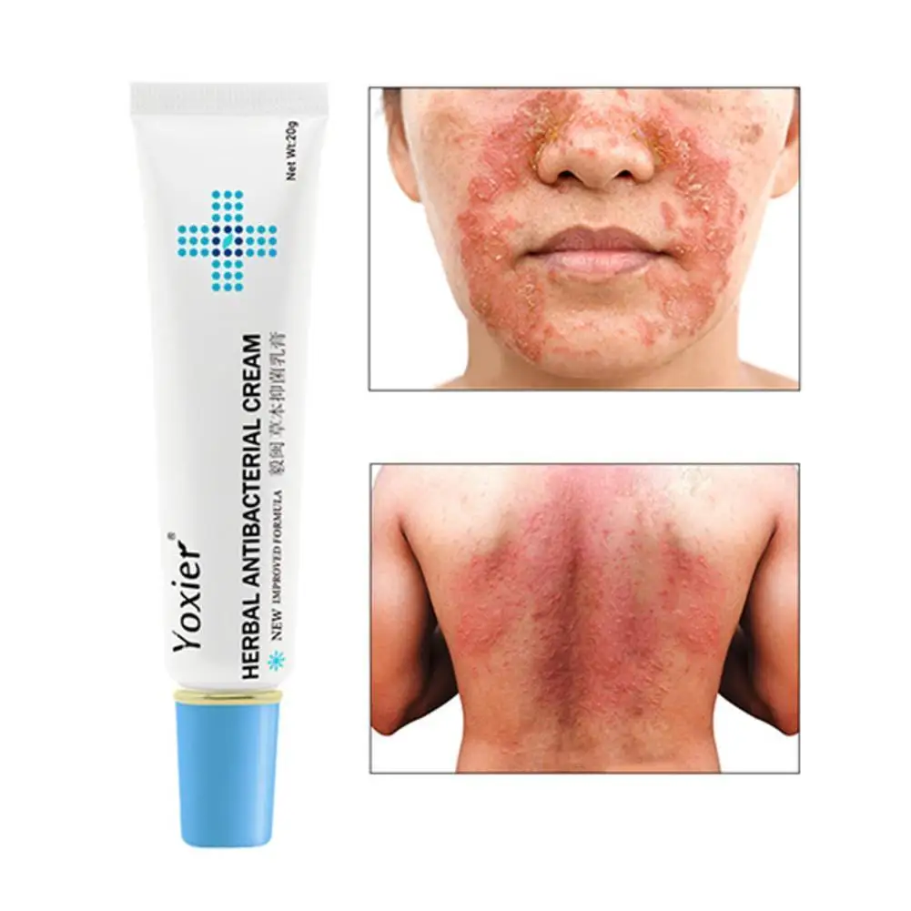 20g Herbal Antibacterial Cream Antipruritic Relief Antibacterial Psoriasis Eczema Urticaria Cream Treatment Skin Rash I4X0
20g Herbal Antibacterial Cream Antipruritic Relief Antibacterial Psoriasis Eczema Urticaria Cream Treatment Skin Rash I4X0