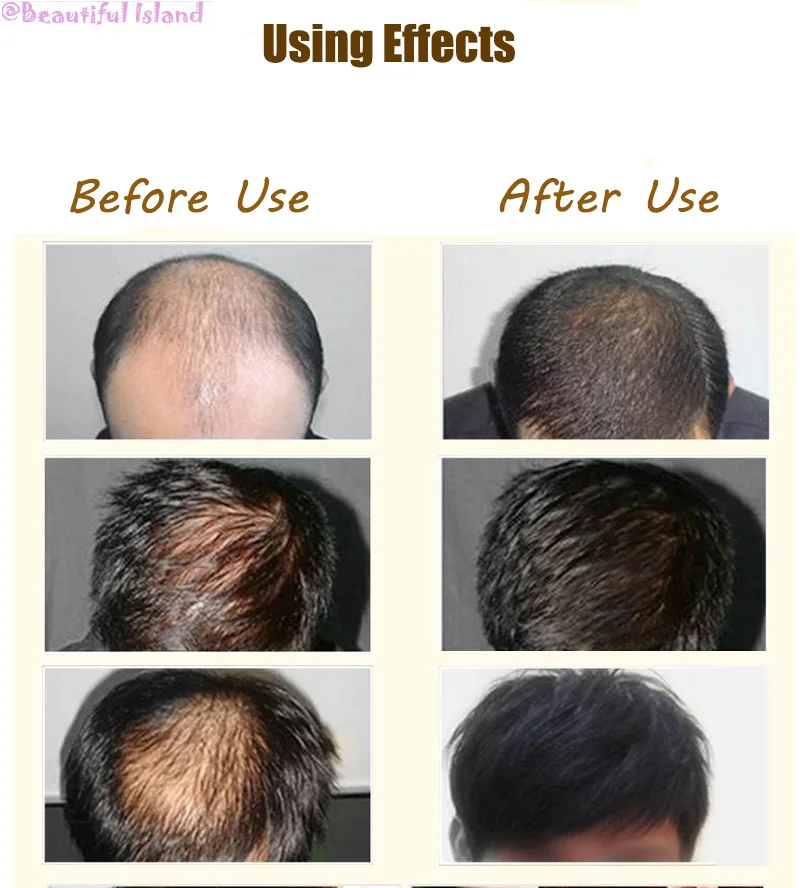 Ginger Hair Growth Essence Fast Thick For Anti-Hair Loss Damaged Hair Repair Longer Thicker Natural Hair Care Product 30ML
Ginger Hair Growth Essence Fast Thick For Anti-Hair Loss Damaged Hair Repair Longer Thicker Natural Hair Care Product 30ML