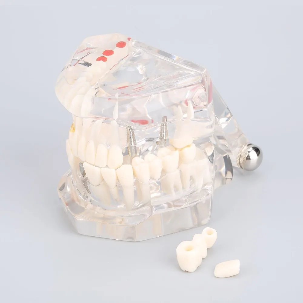 Dental supplies Removable dental restoration model Pathological tooth model Active tooth model Dental implant model
Dental supplies Removable dental restoration model Pathological tooth model Active tooth model Dental implant model