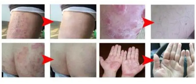 Skin antibacterial ointment, specially for the treatment of psoriasis dermatitis and eczema skin pruritus /15ml x 5pcs
Skin antibacterial ointment, specially for the treatment of psoriasis dermatitis and eczema skin pruritus /15ml x 5pcs