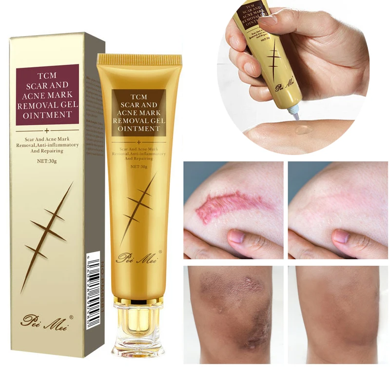 30g Acne Scar Removal Cream Pimples Stretch Marks Face Gel Remove Acne Smoothing Whitening Moisturizing Body Skin Care Aichun 
30g Acne Scar Removal Cream Pimples Stretch Marks Face Gel Remove Acne Smoothing Whitening Moisturizing Body Skin Care Aichun