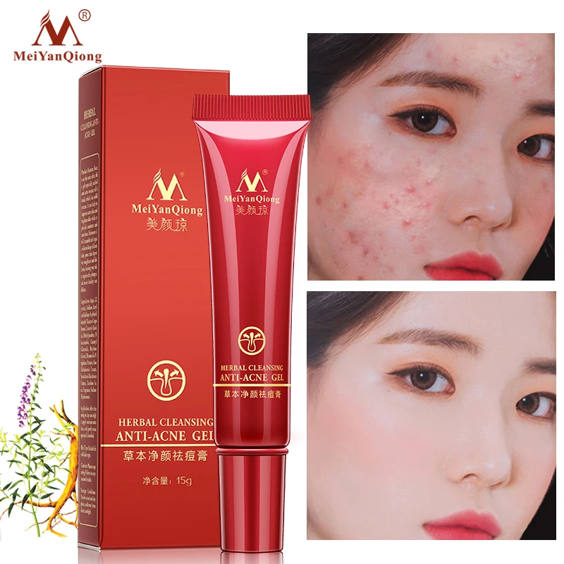 Anti-Acne-Cream Herbal Cleaning Acne Treatment Remove Whitening Face Care Acne Scar Remove Oil Control Skin Care gel
Anti-Acne-Cream Herbal Cleaning Acne Treatment Remove Whitening Face Care Acne Scar Remove Oil Control Skin Care gel