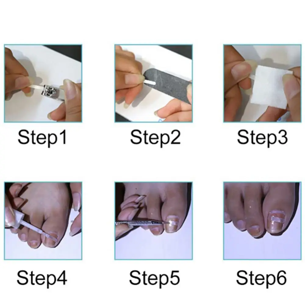 50% Hot Sale Paronychia Nail Glue Ingrown Toenail Correction Pedicure Toe Patch Foot Care 8g
50% Hot Sale Paronychia Nail Glue Ingrown Toenail Correction Pedicure Toe Patch Foot Care 8g