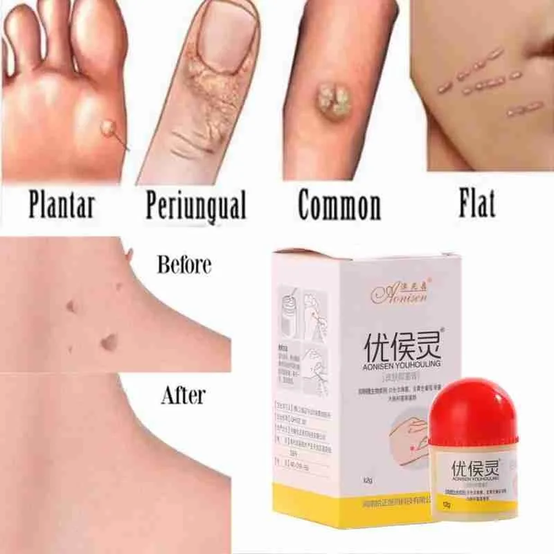 1 шт., жидкость для удаления бородавок и бородавок
1 шт., жидкость для удаления бородавок и бородавок