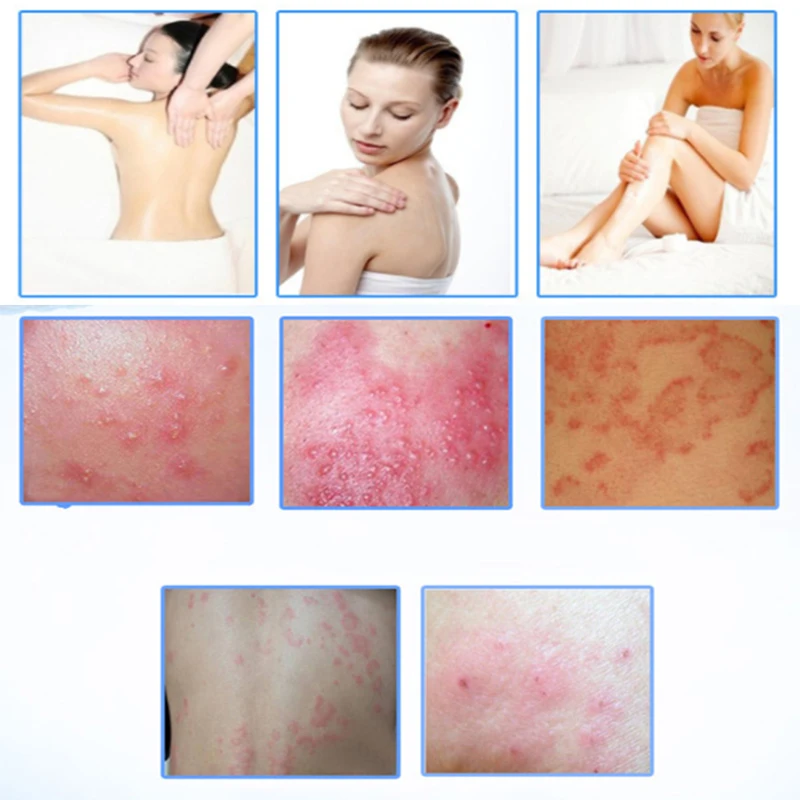 Eczema Cream Herb Psoriasis Ointment Dermatitis Eczematoid Bacteriostasis Eczema Treatment Skin Care Eczema Cream
Eczema Cream Herb Psoriasis Ointment Dermatitis Eczematoid Bacteriostasis Eczema Treatment Skin Care Eczema Cream