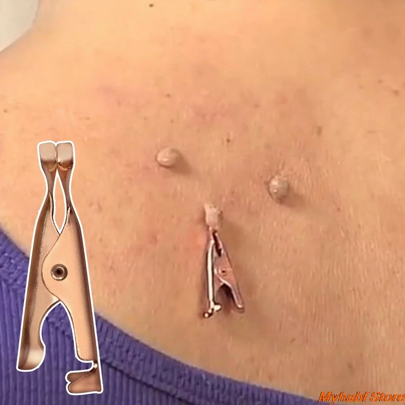1/3/5pcs Skin Tags Remover Wart Tattoo Clip Blackhead Skin Blemish Removers Copper Tags Out Face Acne Pimple Remover Beauty Tool
1/3/5pcs Skin Tags Remover Wart Tattoo Clip Blackhead Skin Blemish Removers Copper Tags Out Face Acne Pimple Remover Beauty Tool