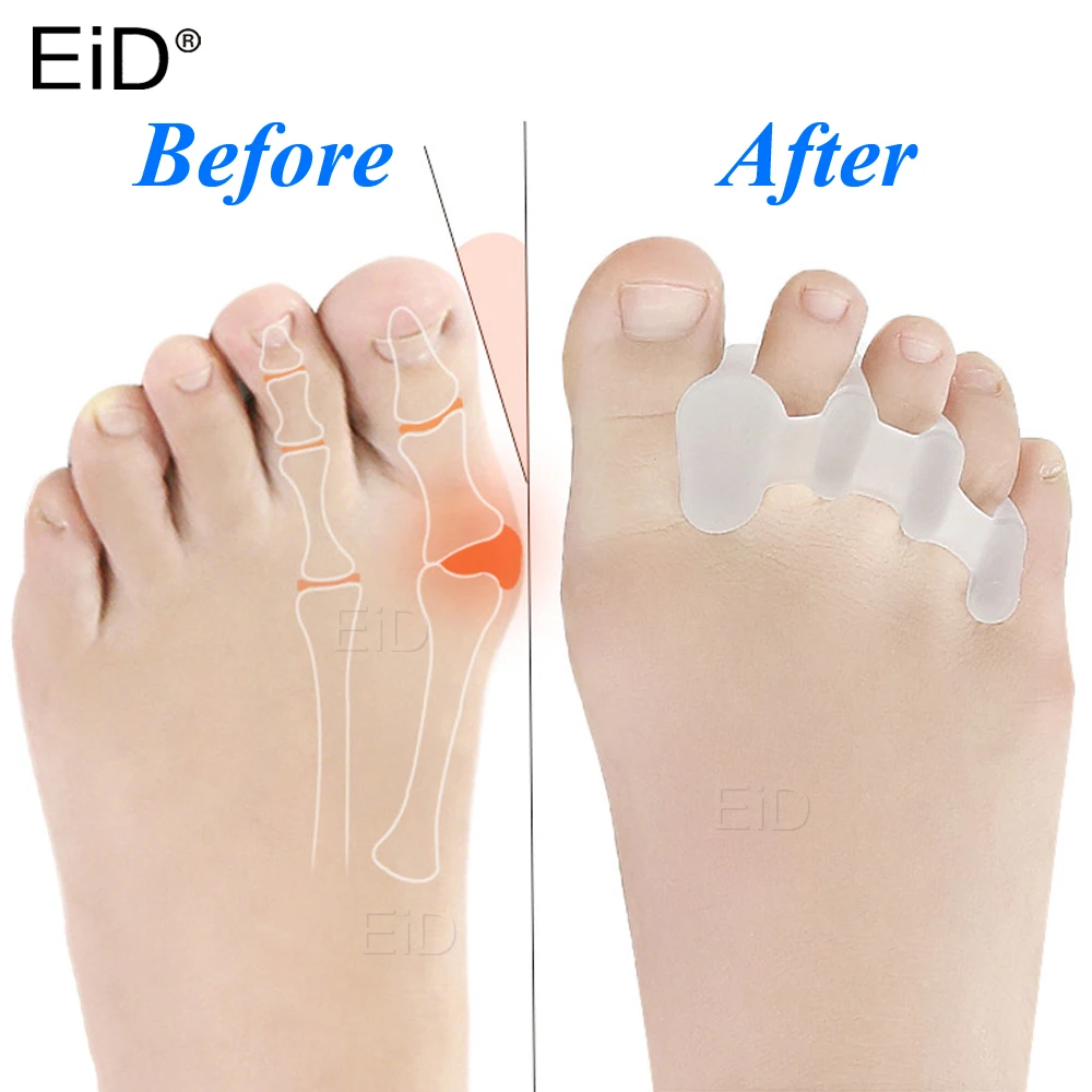 EiD 2 Pcs Silicone Gel Hallux Valgus Orthotics Bunion Toes Separator Corrector Inserts Pad Anti Eversion Overlap Inserts Pad
EiD 2 Pcs Silicone Gel Hallux Valgus Orthotics Bunion Toes Separator Corrector Inserts Pad Anti Eversion Overlap Inserts Pad