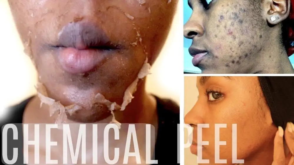 50% TCA Skin Peel Acid (1 Oz.) Skin Tags, Age Spots, White Spots, Stretch Marks Free Shipping
50% TCA Skin Peel Acid (1 Oz.) Skin Tags, Age Spots, White Spots, Stretch Marks Free Shipping
